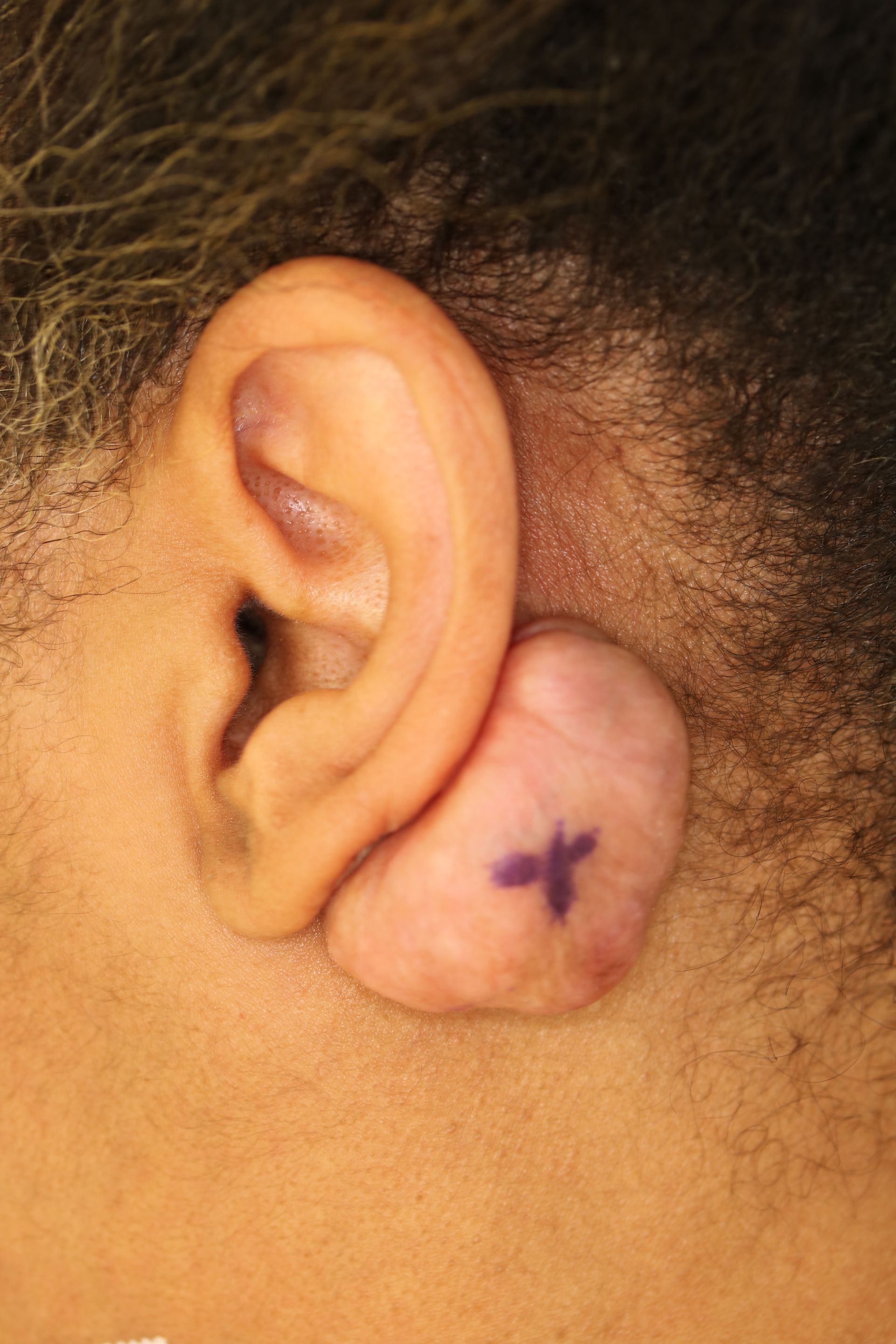 A close up of a person 's ear with a purple cross on it. A before picture of keloid removal in Leawood, KS