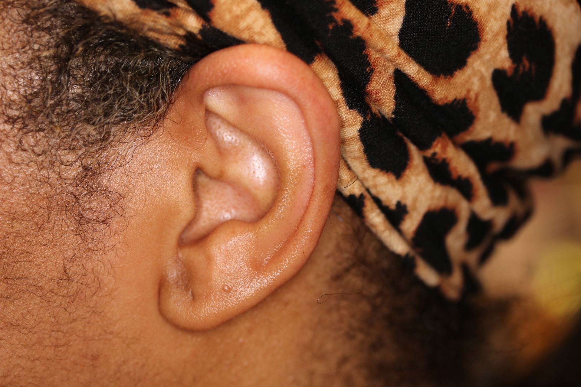 A close up of a woman 's ear with a leopard print headband. An after picture of keloid removal in Leawood, KS