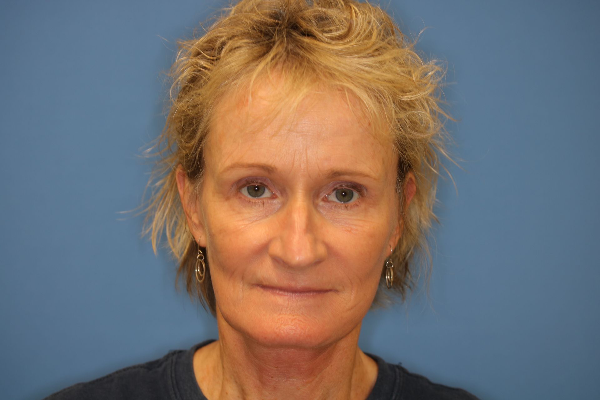 A woman with short blonde hair is standing in front of a blue wall who underwent bilateral upper blepharoplasty