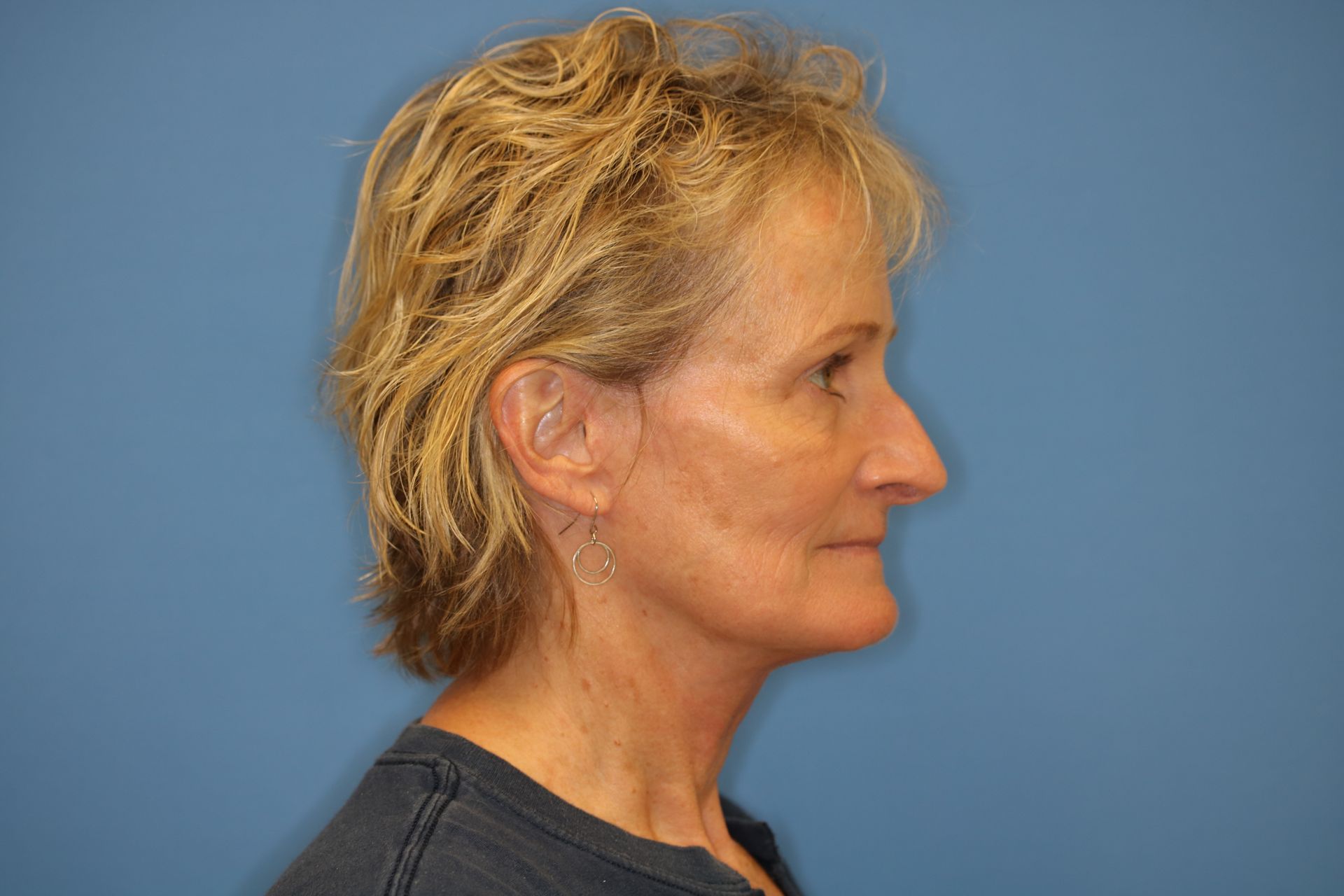 A woman with short blonde hair is standing in front of a blue wall who underwent bilateral upper blepharoplasty