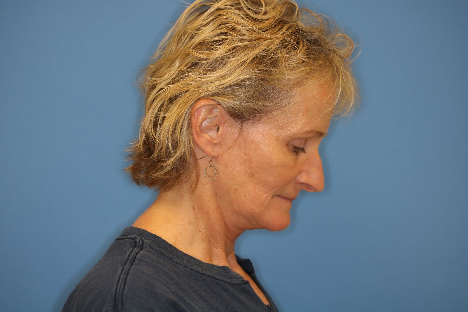 A woman with short blonde hair is standing in front of a blue wall who underwent bilateral upper blepharoplasty