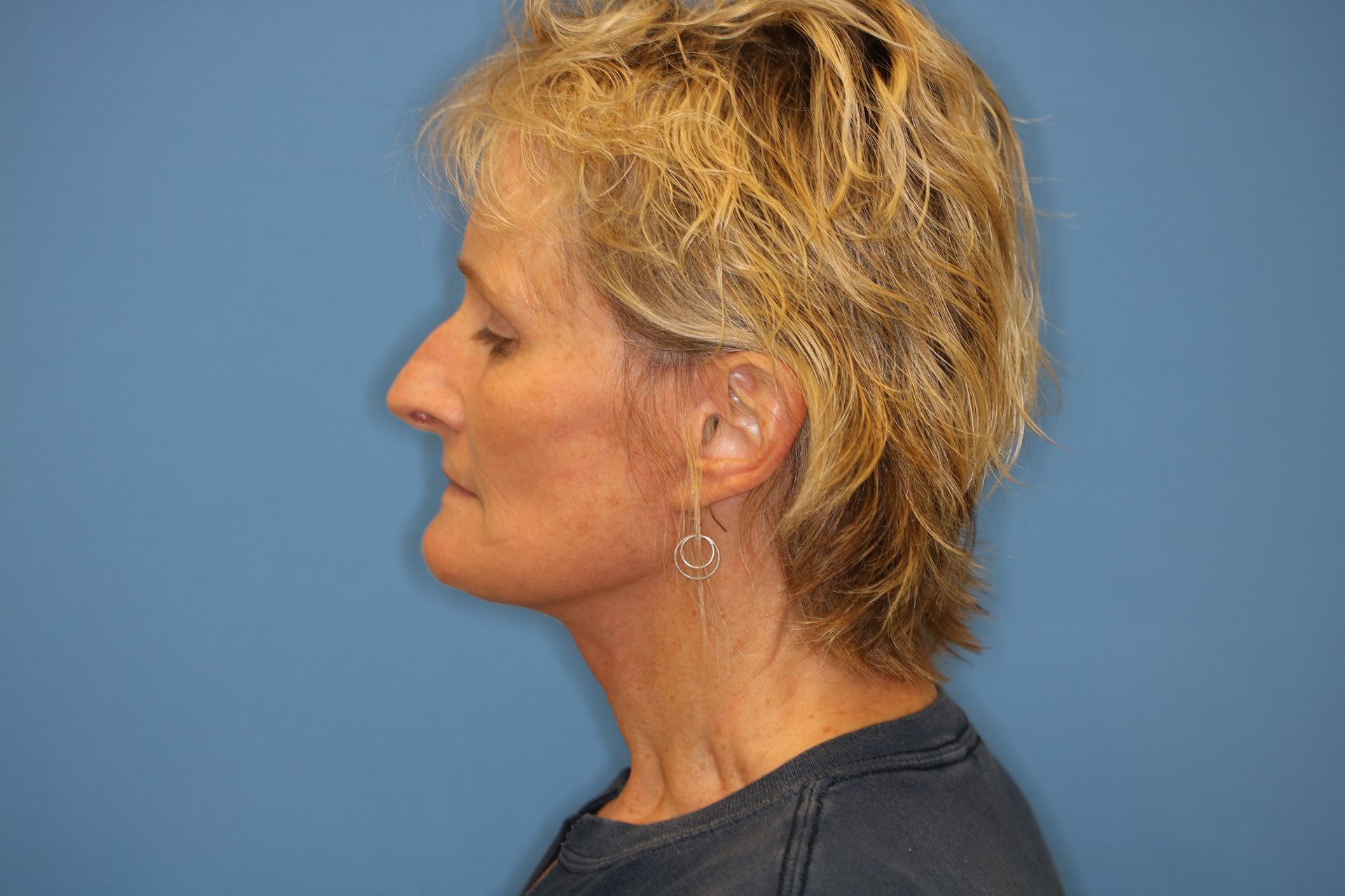 A woman with short blonde hair is standing in front of a blue wall who underwent bilateral upper blepharoplasty