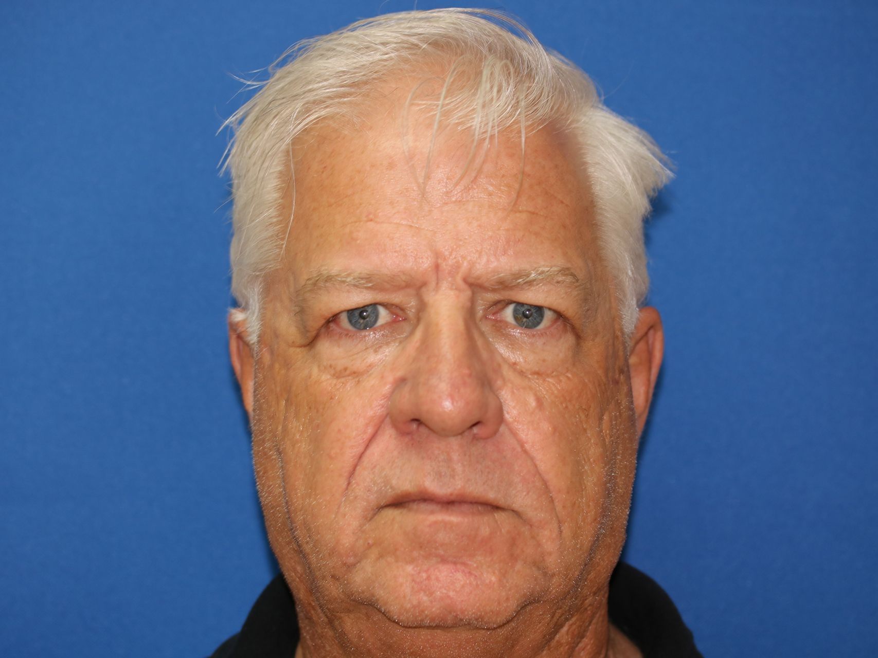 58 year old man who underwent bilateral upper blepharoplasty in office under local anesthesia