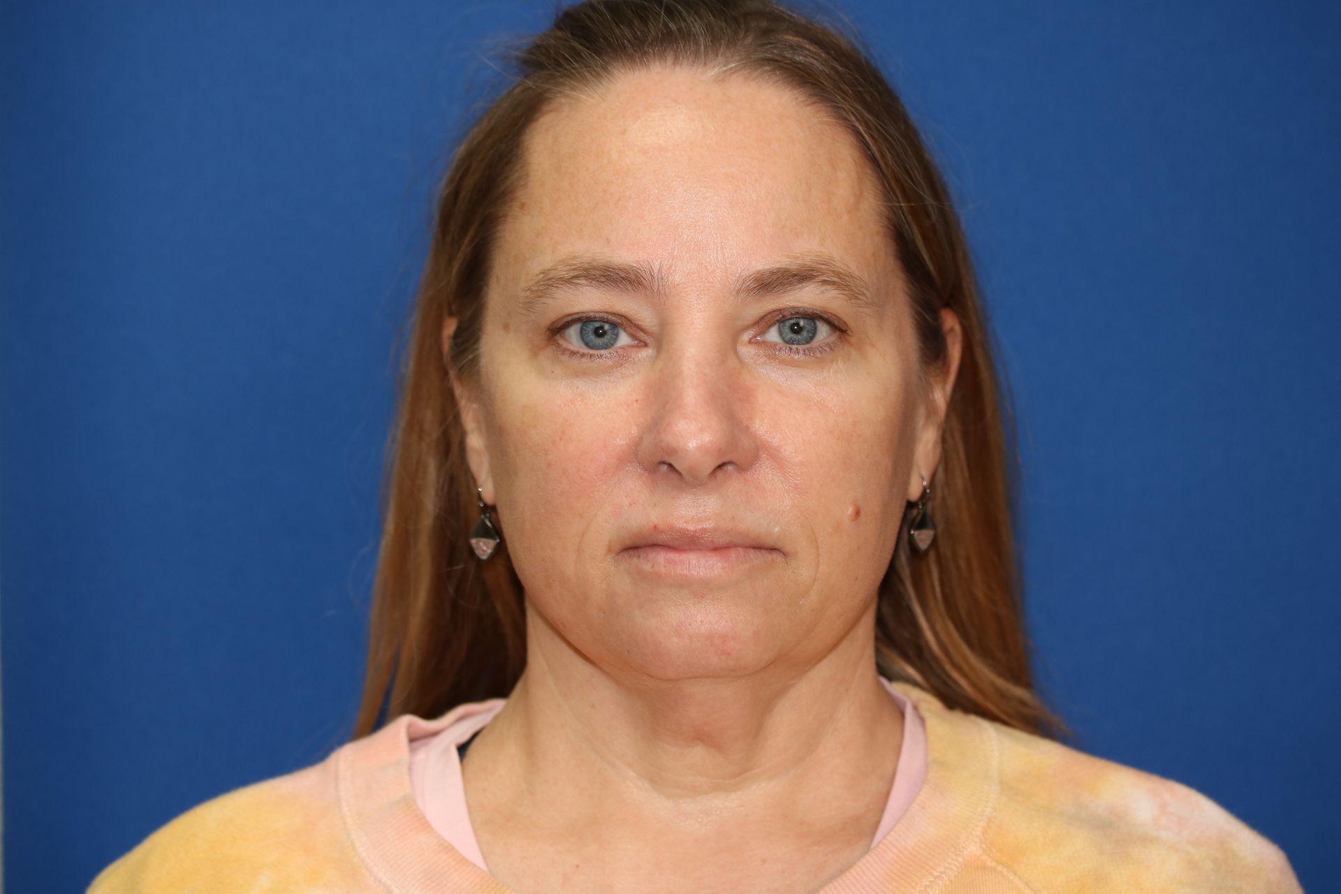 65 year old female underwent deep plane face and neck lift