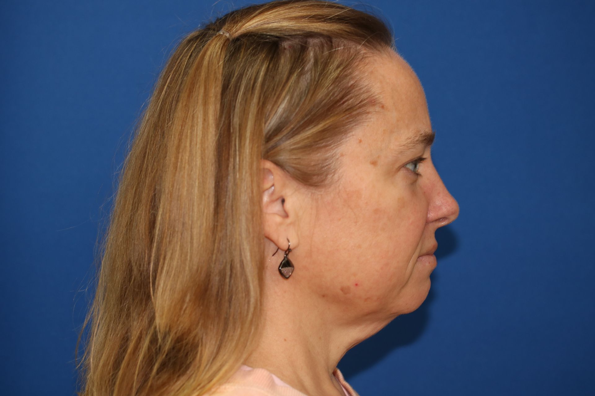 65 year old female underwent deep plane face and neck lift