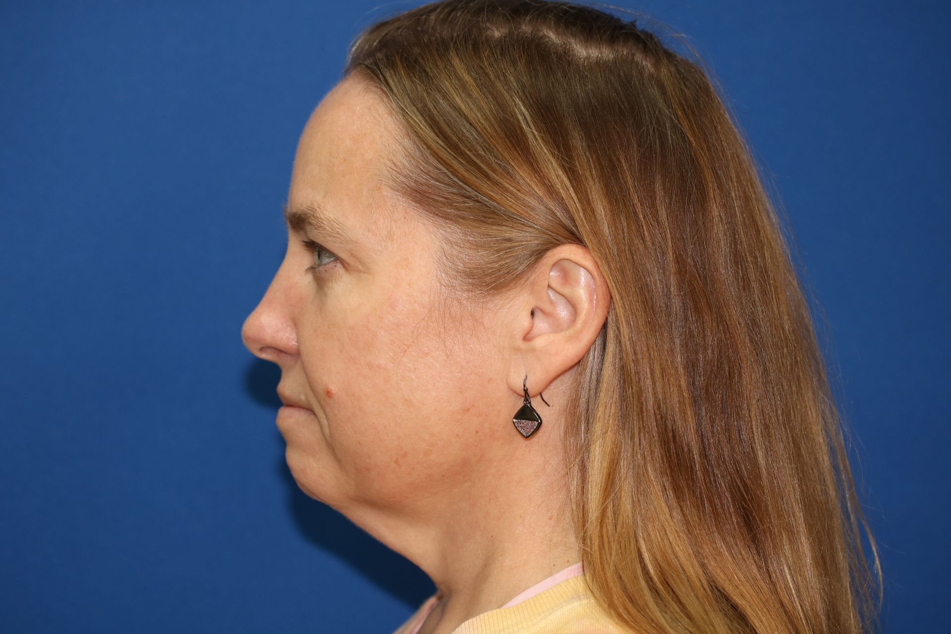 65 year old female underwent deep plane face and neck lift