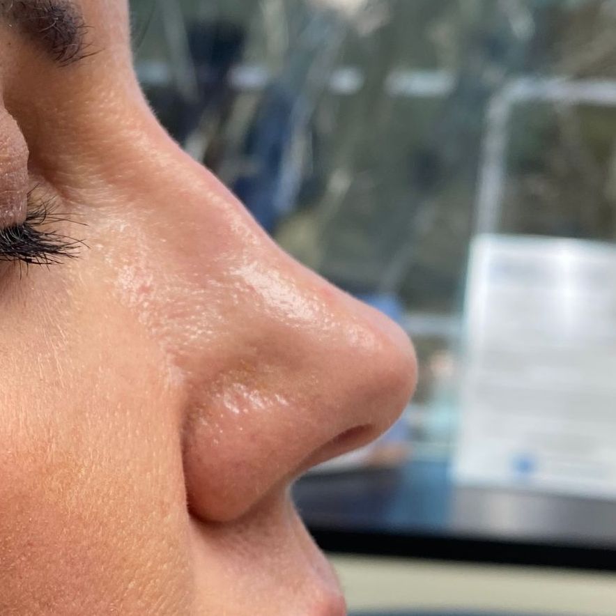 A before picture of a woman who underwent Liquid Rhinoplasty at Carson Williams MD Facial Plastic Surgery in leawood, KS