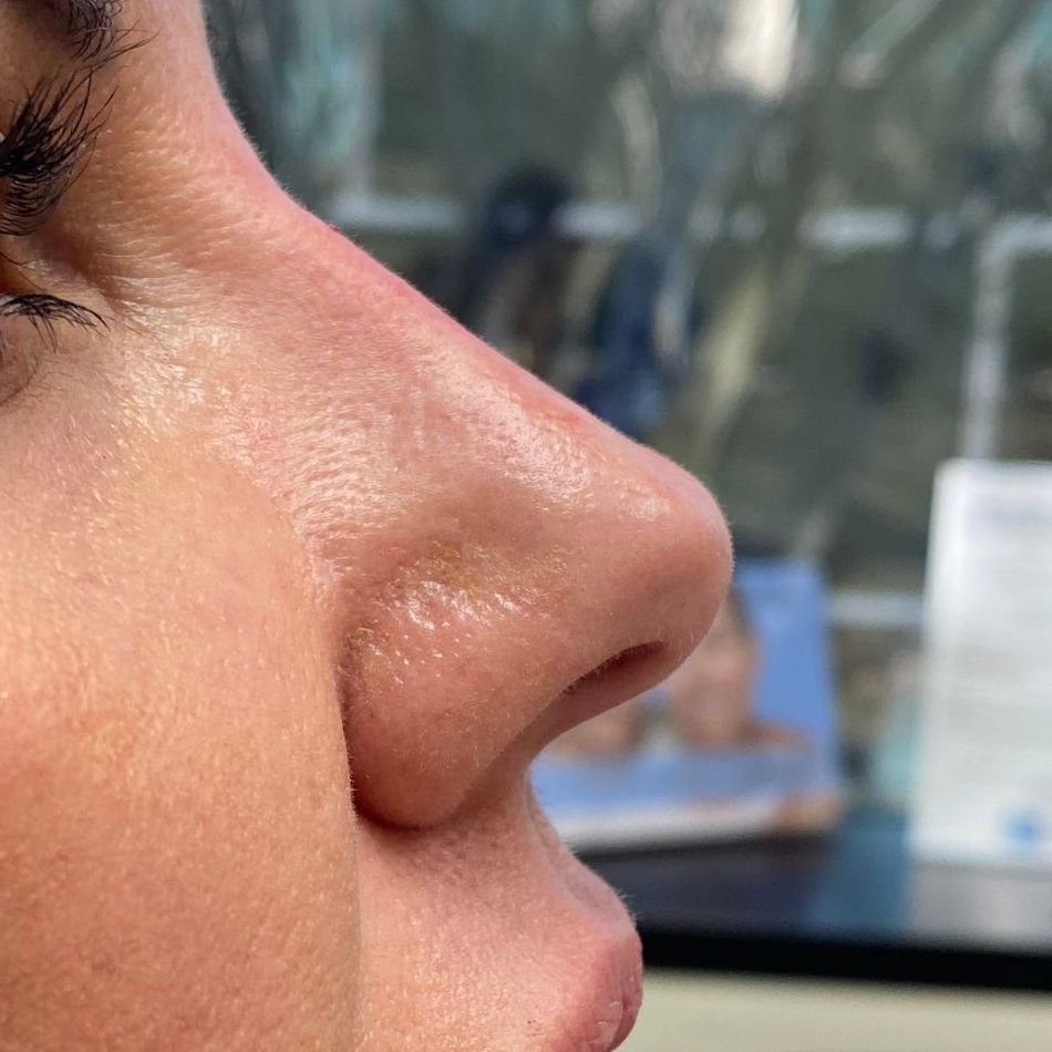 An after picture of a woman who underwent Liquid Rhinoplasty at Carson Williams MD Facial Plastic Surgery in leawood, KS