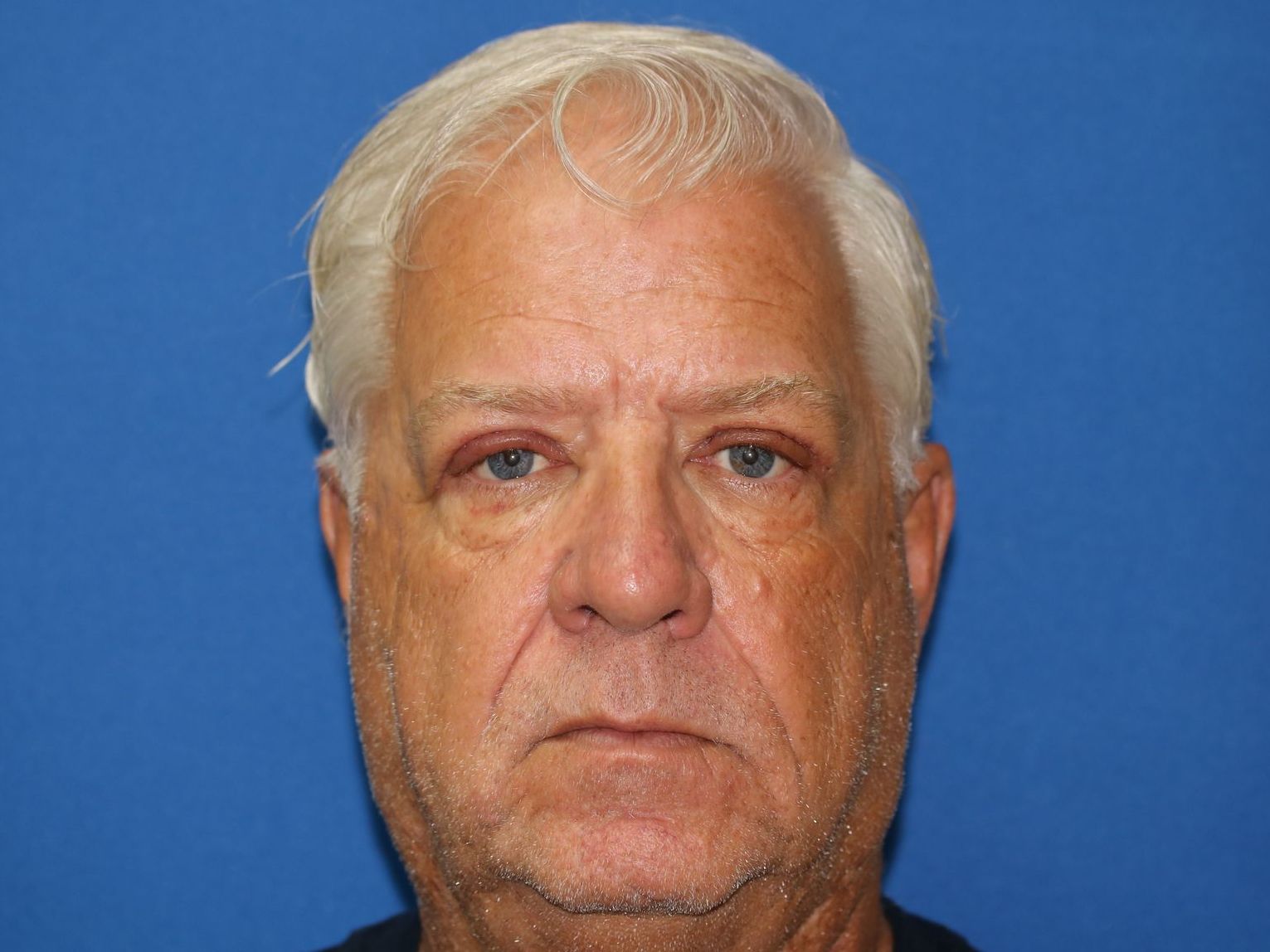 58 year old man who underwent bilateral upper blepharoplasty in office under local anesthesia