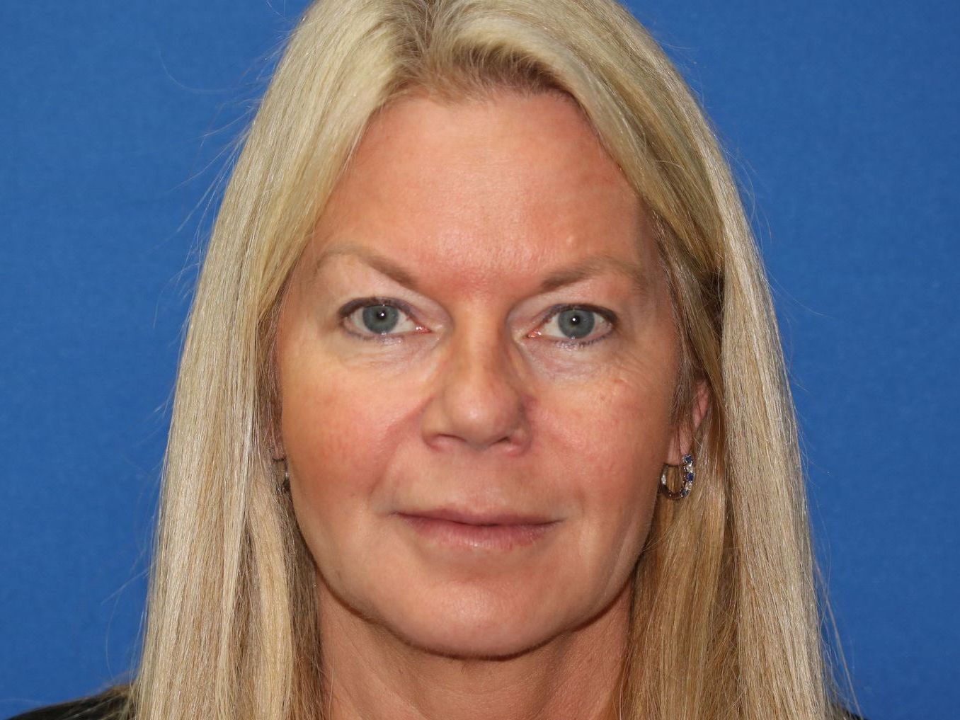 55 year old female who underwent bilateral upper blepharoplasty under local anesthesia in office