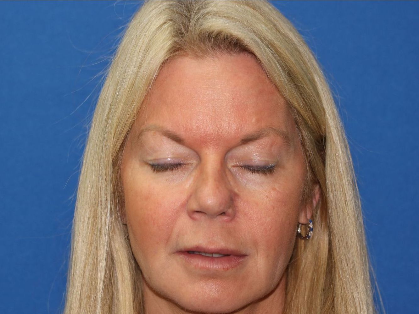 55 year old female who underwent bilateral upper blepharoplasty under local anesthesia in office