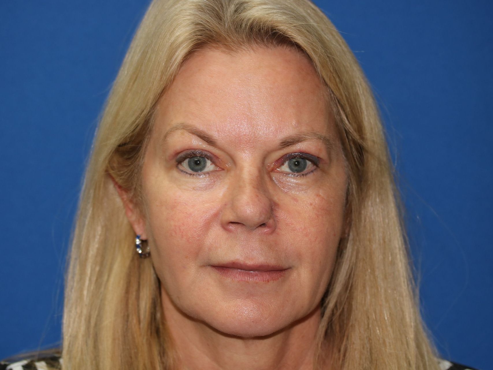 55 year old female who underwent bilateral upper blepharoplasty under local anesthesia in office