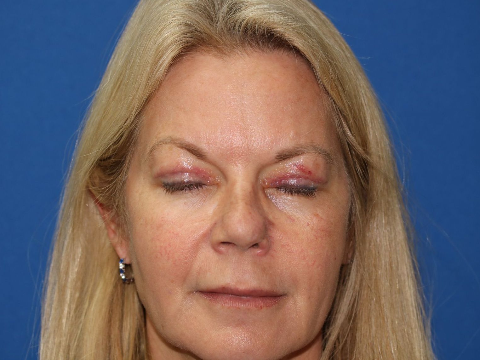 55 year old female who underwent bilateral upper blepharoplasty under local anesthesia in office