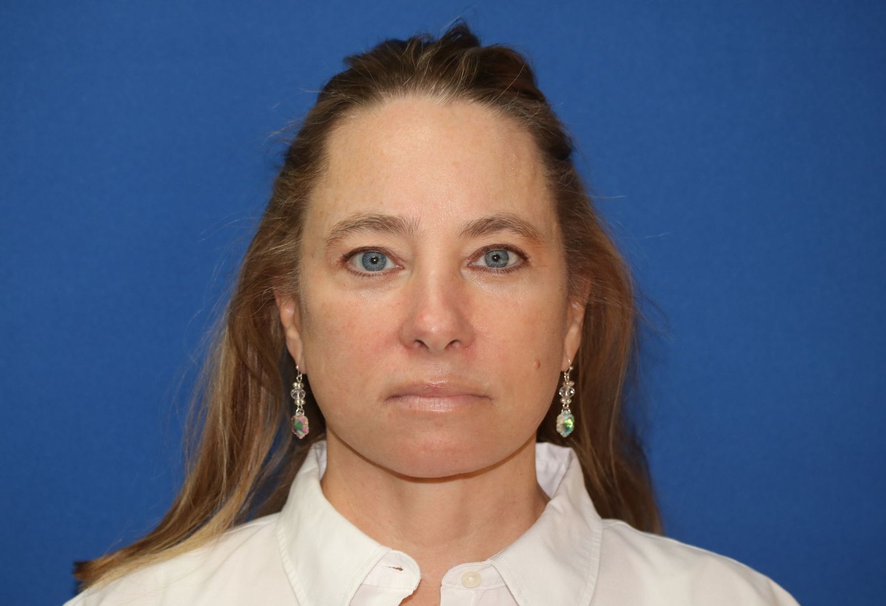 65 year old female underwent deep plane face and neck lift