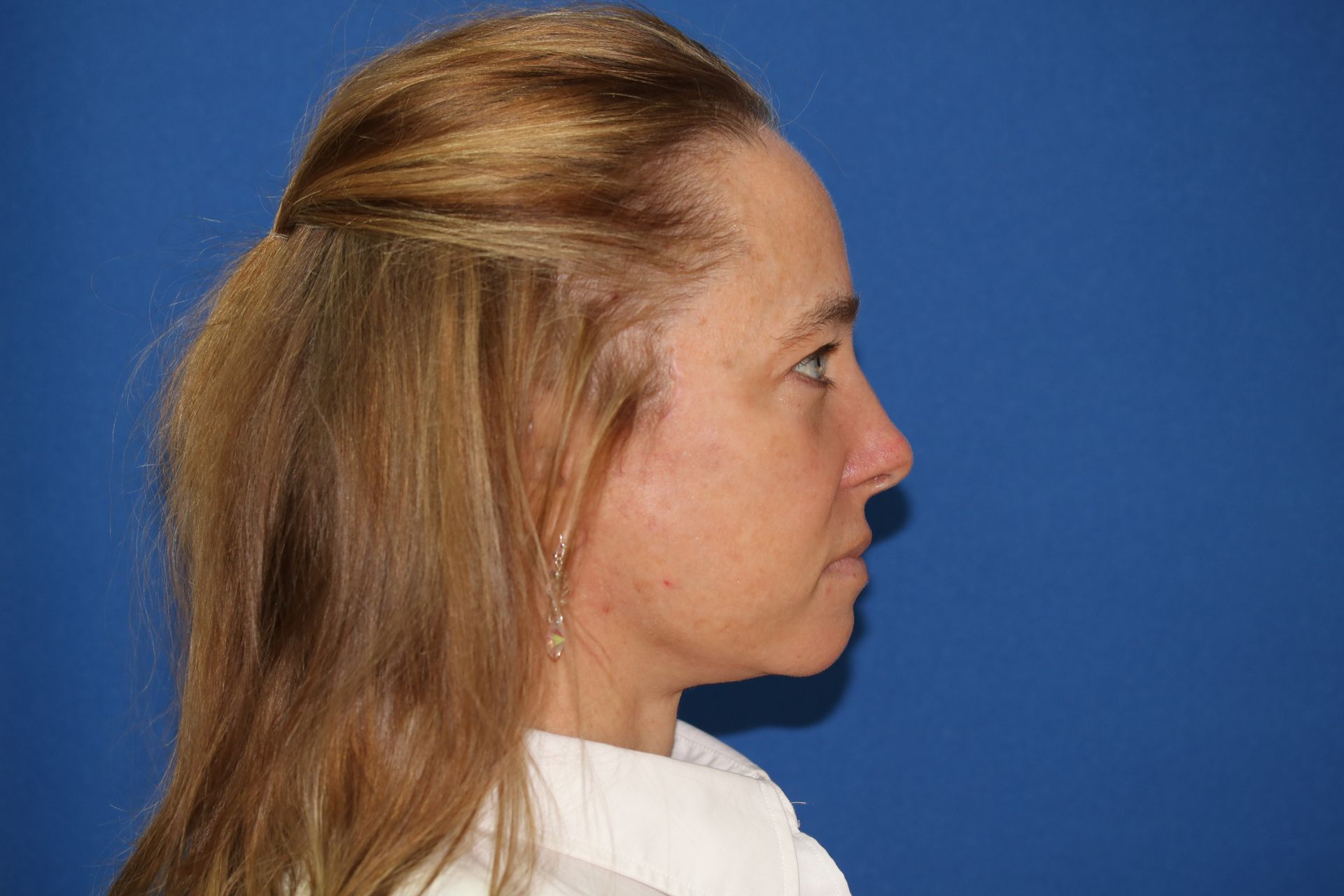 Side image of women who underwent deep plane facelift surgery in Leawood, KS