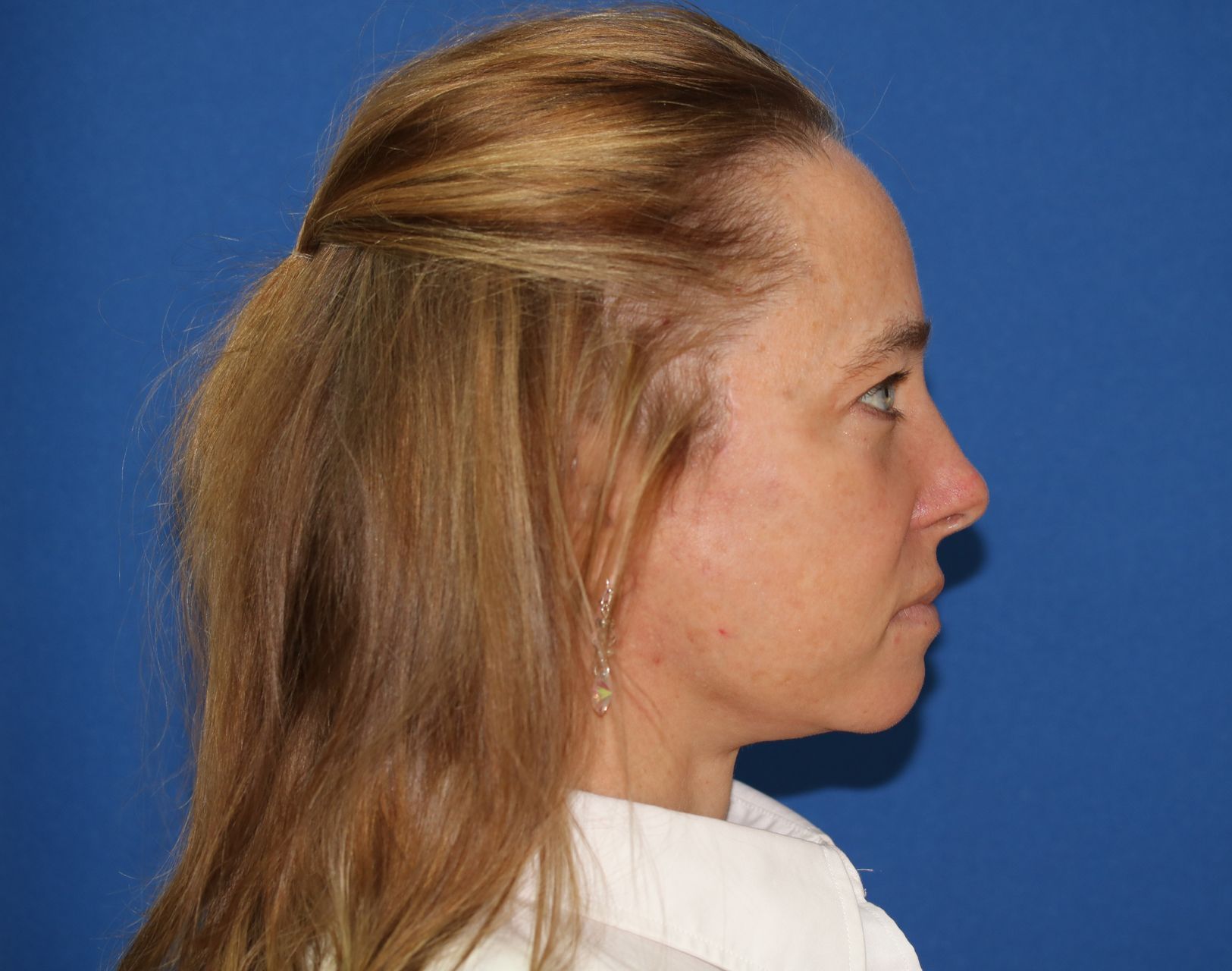 65 year old female underwent deep plane face and neck lift