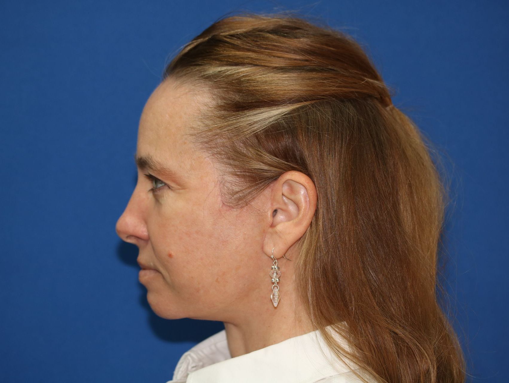 65 year old female underwent deep plane face and neck lift