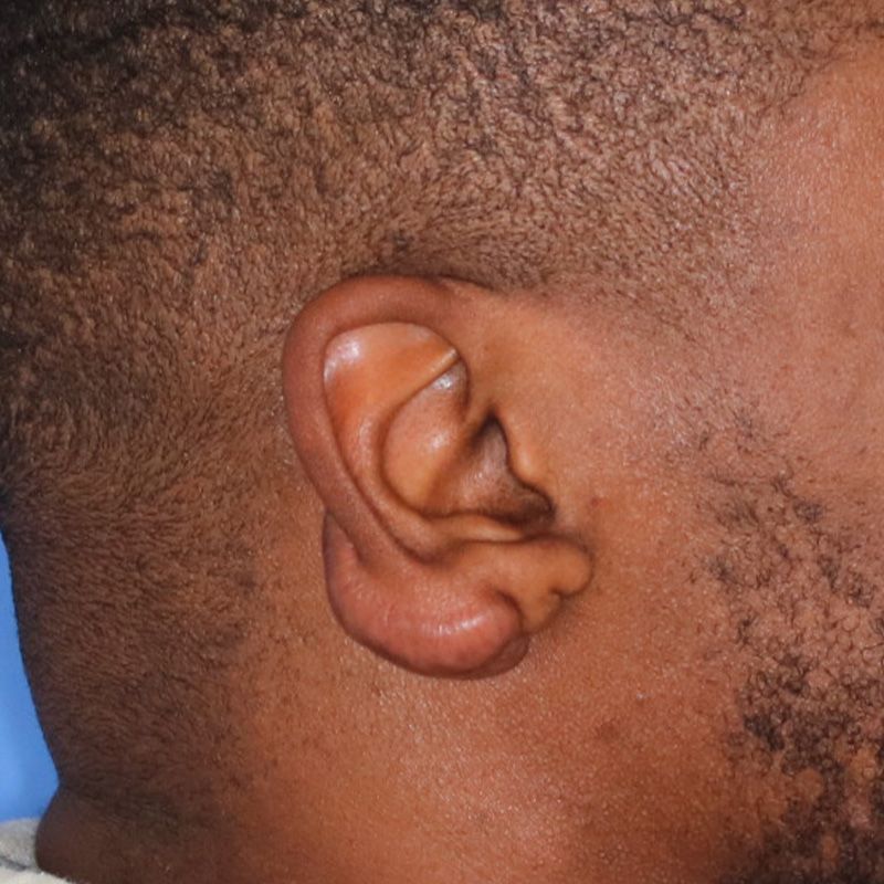 Close up of a man's ear who had Keloid Removal surgery at Carson Williams Facial Plastic Surgery in Leawood, KS