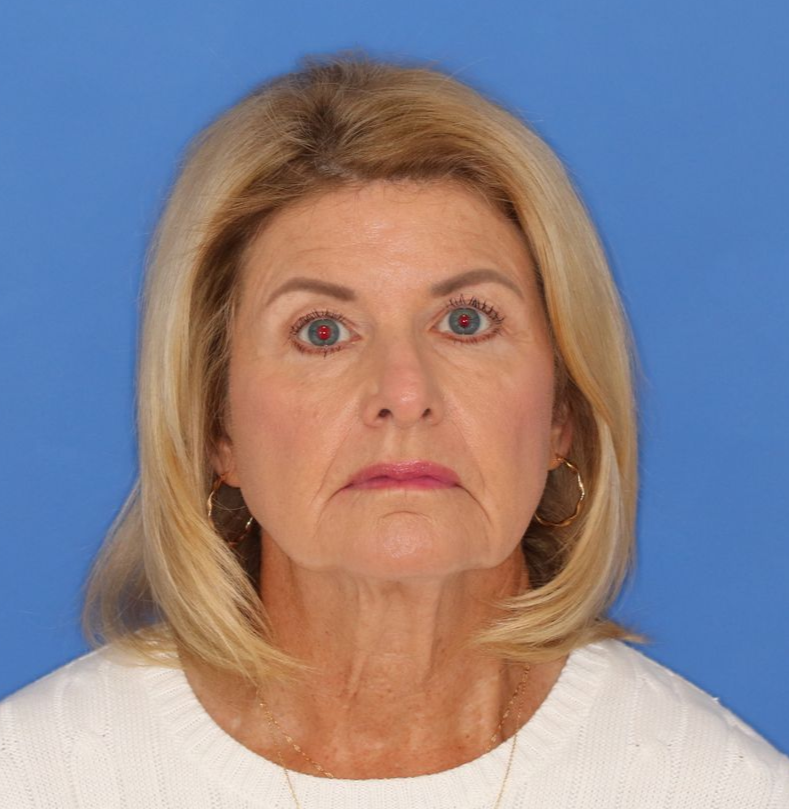 71 year old female posing on a blue background for a before photo