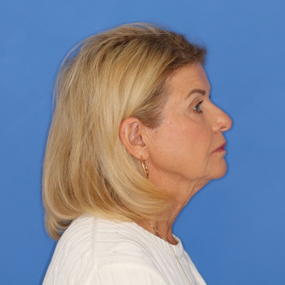 71 year old female posing for a before photo