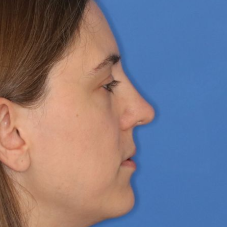 Woman posing in front of a blue background after receiving a rhinoplasty