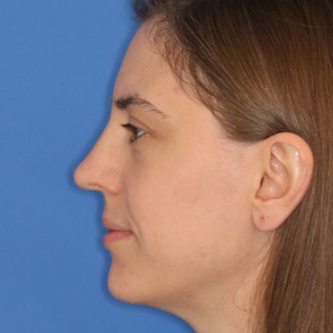 After Rhinoplasty at Carson Williams, MD Facial Plastic Surgery in Leawood, KS