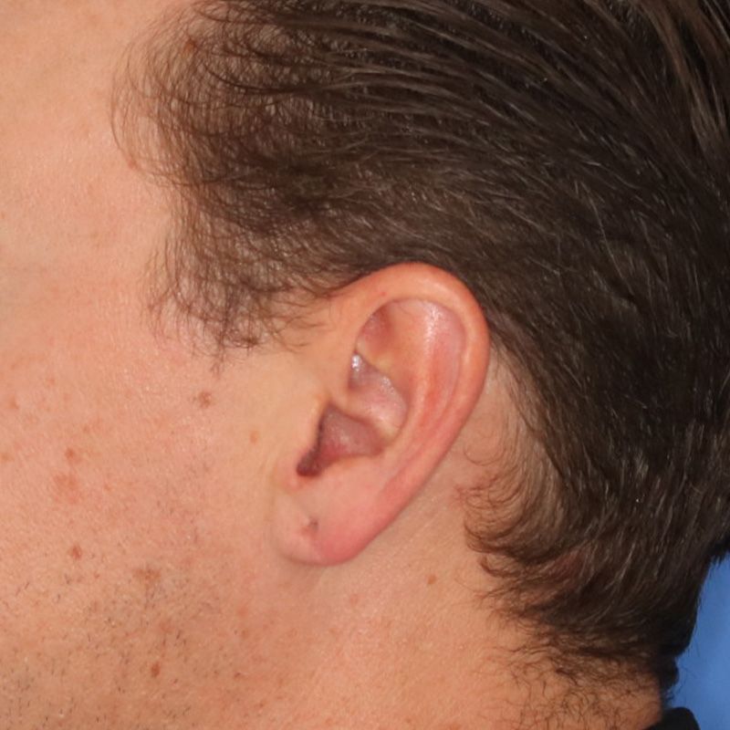 Close up of a person before earlobe repair at Carson Williams Facial Plastic Surgery in Leawood, KS