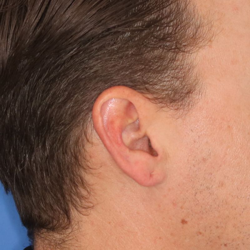 Close up of a person before earlobe repair at Carson Williams Facial Plastic Surgery in Leawood, KS