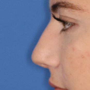 Close up of a woman before liquid rhinoplasty at Carson Williams Facial Plastic Surgery in Leawood, KS