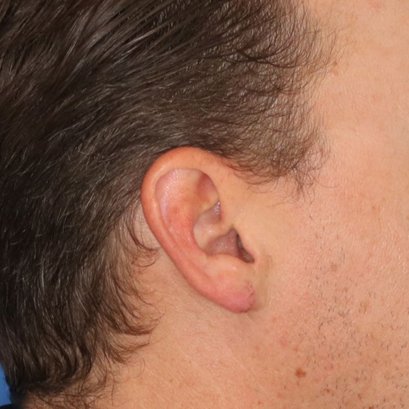 Close up of a person after earlobe repair at Carson Williams Facial Plastic Surgery in Leawood, KS