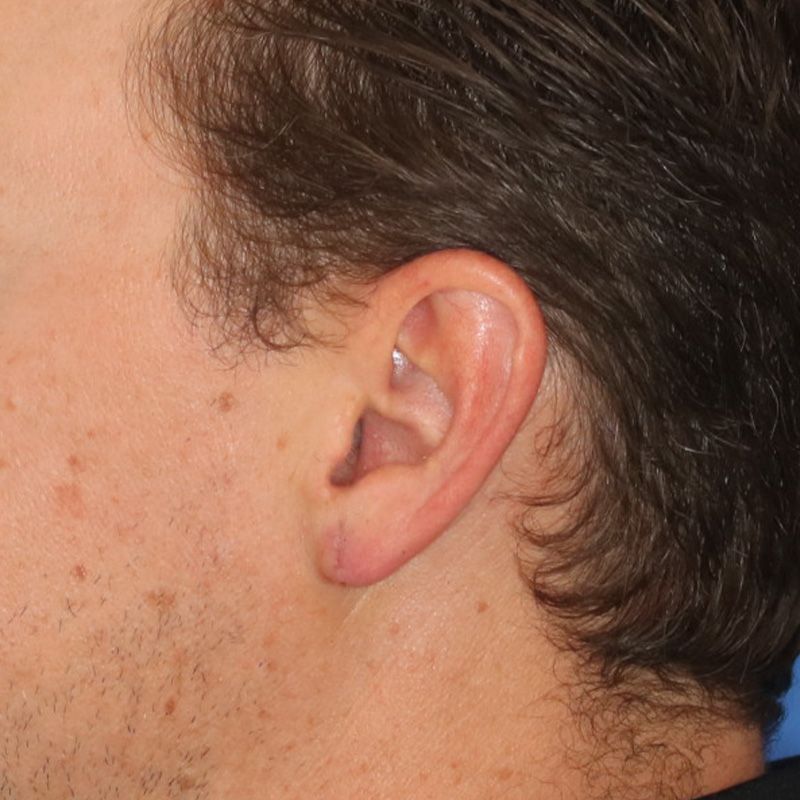 Close up of a person afterearlobe repair at Carson Williams Facial Plastic Surgery in Leawood, KS