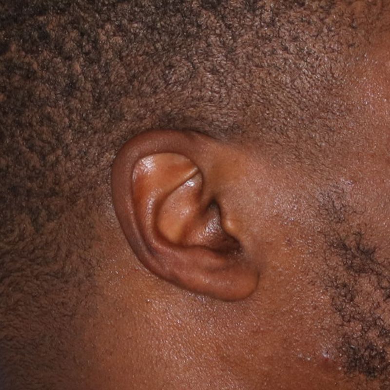 Close up of a man's ear who had Keloid Removal surgery at Carson Williams Facial Plastic Surgery in Leawood, KS