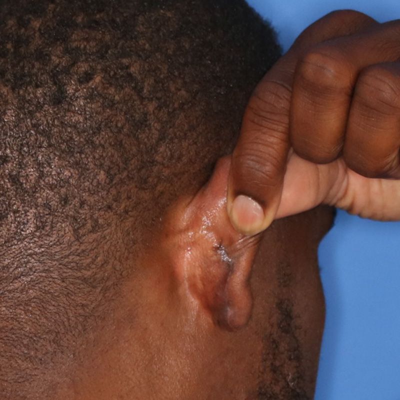 Close up of a man's ear who had Keloid Removal surgery at Carson Williams Facial Plastic Surgery in Leawood, KS