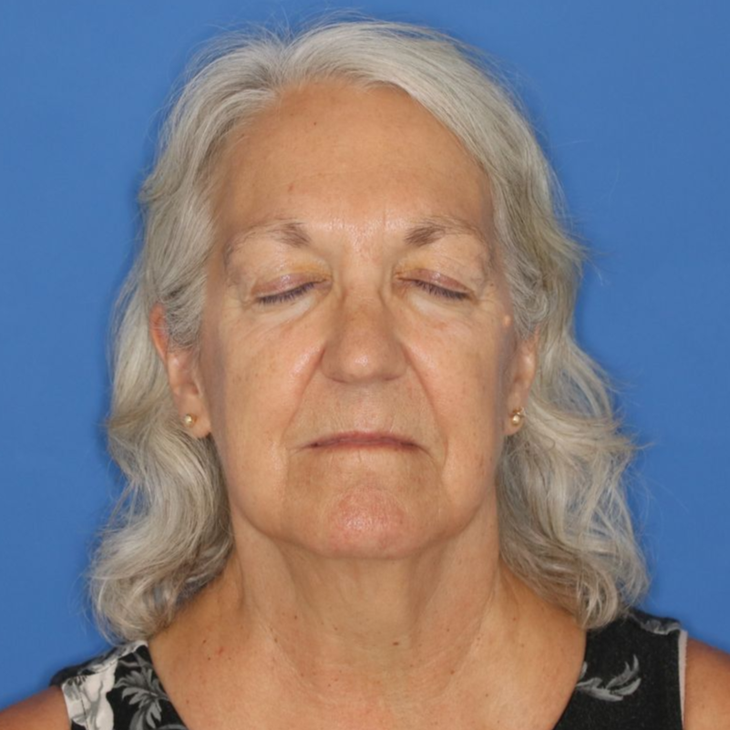 67 year old female with her eyes closed posing for a before photo who underwent bilateral upper blepharoplasty.