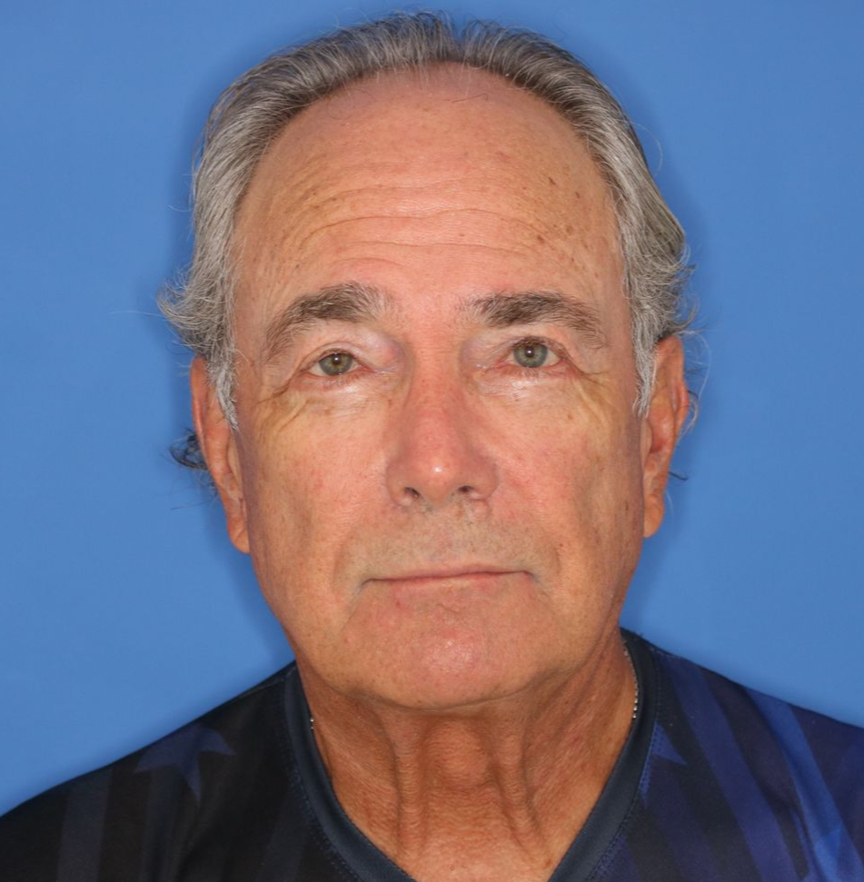 A 72 year old male posing for after photos of a bilateral upper blepharoplasty under local anesthesia in office.