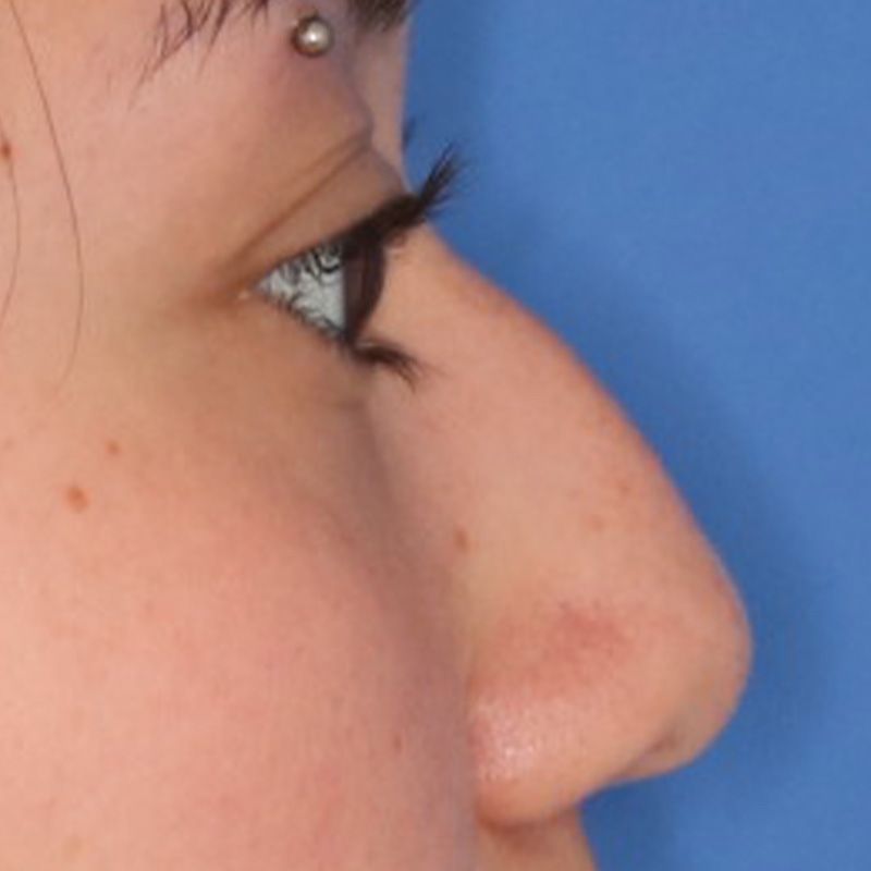 Close up of a woman before liquid rhinoplasty at Carson Williams Facial Plastic Surgery in Leawood, KS