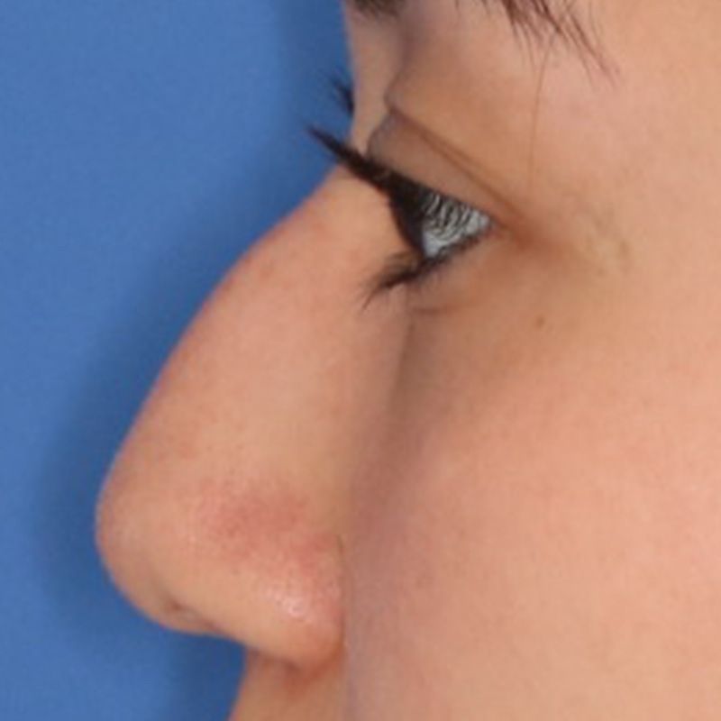 Close up of a woman before liquid rhinoplasty at Carson Williams Facial Plastic Surgery in Leawood, KS