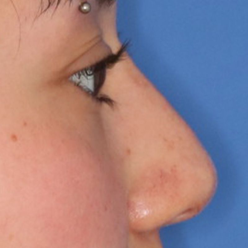 Close up of a woman after liquid rhinoplasty at Carson Williams Facial Plastic Surgery in Leawood, KS