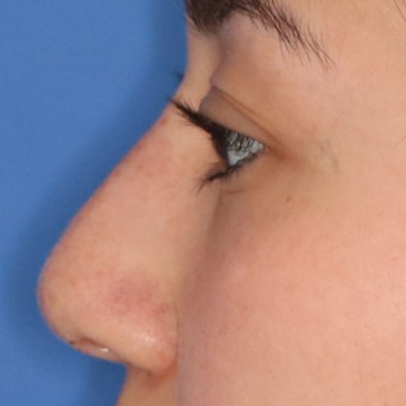 Close up of a woman after liquid rhinoplasty at Carson Williams Facial Plastic Surgery in Leawood, KS