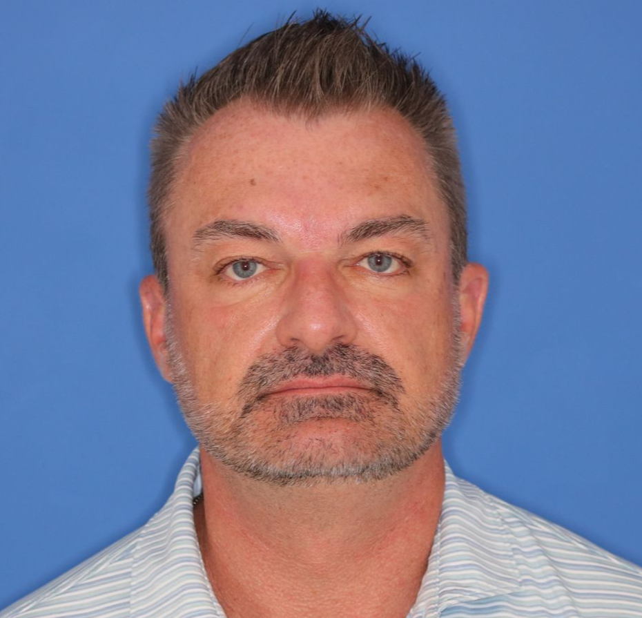 51 year old male posing for a before photo who underwent bilateral upper blepharoplasty.