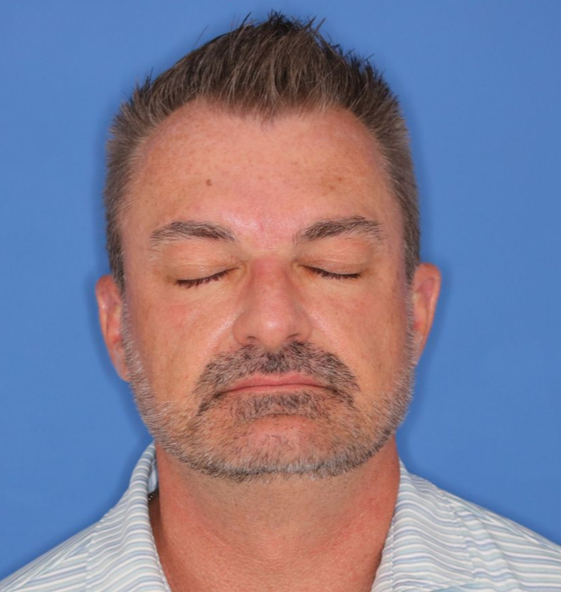 Eyes closed photo of a man posing for a before photo of a blepharoplasty surgery