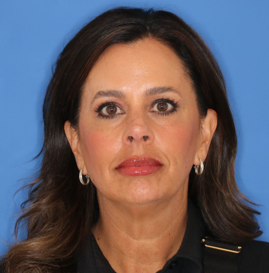 51 year old female before undergoing deep plane face and neck lift, endoscopic brow lift and lower blepharoplasty