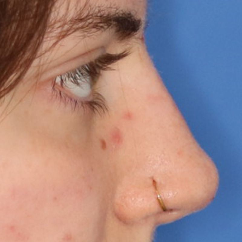 Close up of a woman after liquid rhinoplasty at Carson Williams Facial Plastic Surgery in Leawood, KS