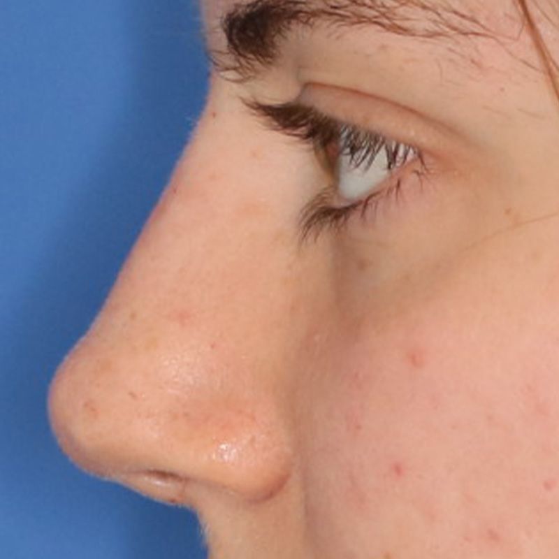 Close up of a woman after liquid rhinoplasty at Carson Williams Facial Plastic Surgery in Leawood, KS