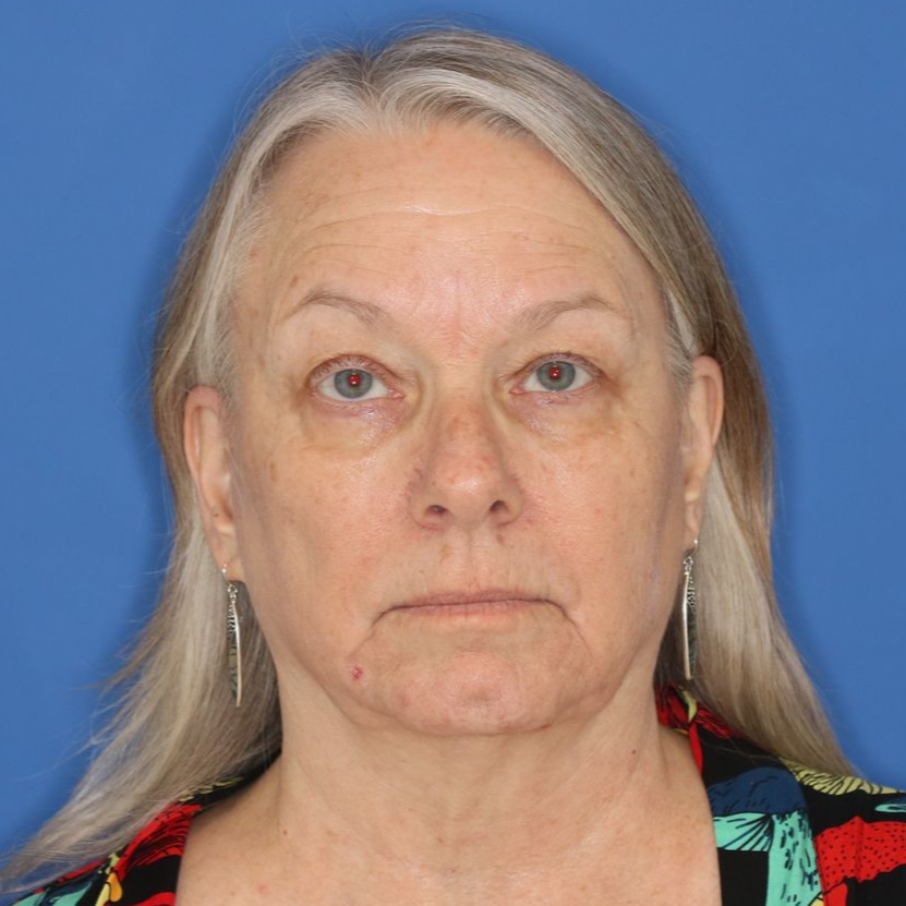 A woman in patterned shirt posing for a before photo of a blepharoplasty.