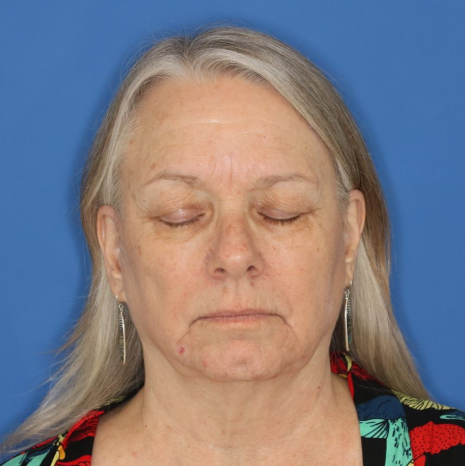 Eyes closed before photo of a 68 year old female posing for a photo who underwent bilateral upper blepharoplasty.