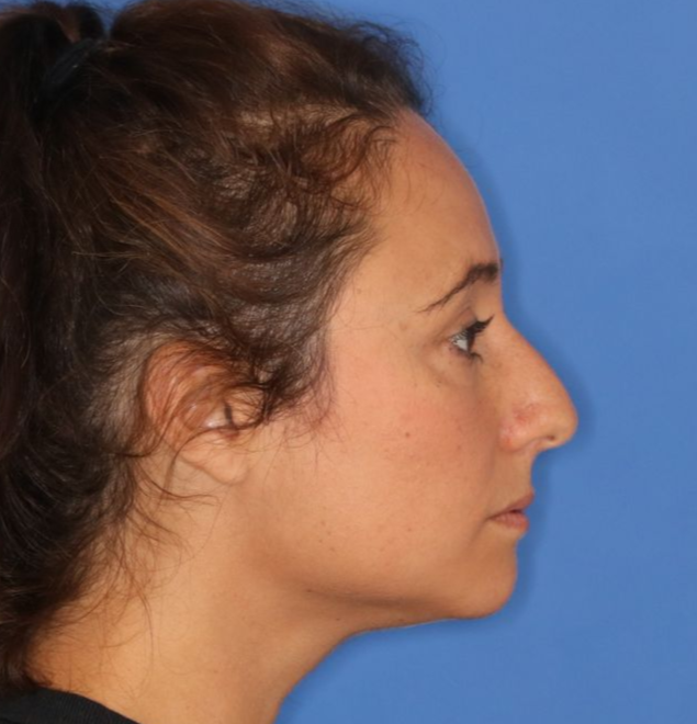 Side profile of a woman before receiving a rhinoplasty