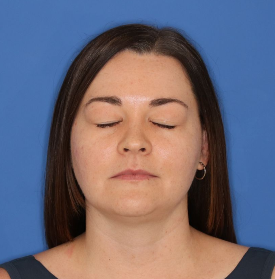 A closed eyed before photo of a blepharoplasty surgery on a 35 year old woman.