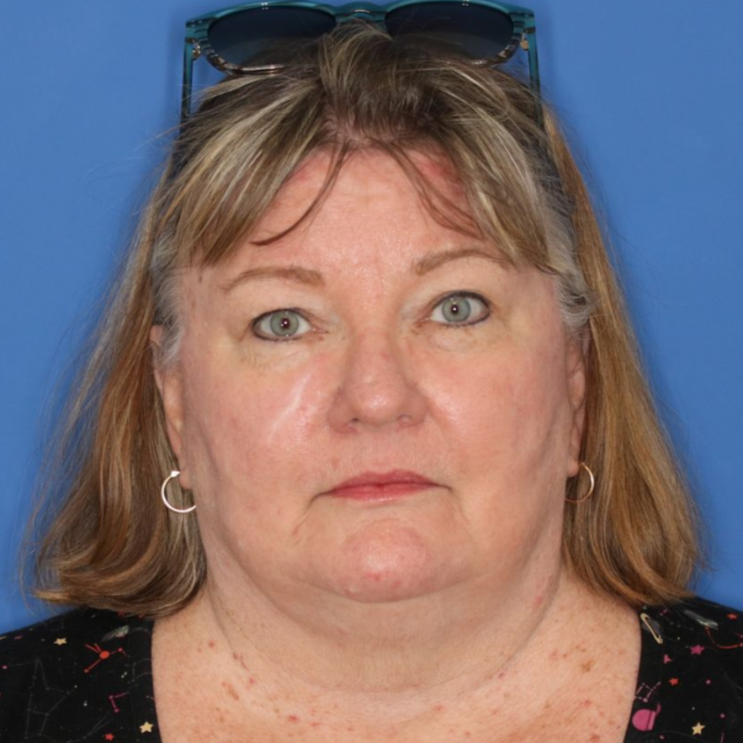 Before photos of a 67 year old female who underwent bilateral upper blepharoplasty.