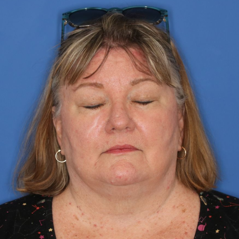 67 year old female patient with her eyes closed posing for a before photo of an bilateral upper blepharoplasty.